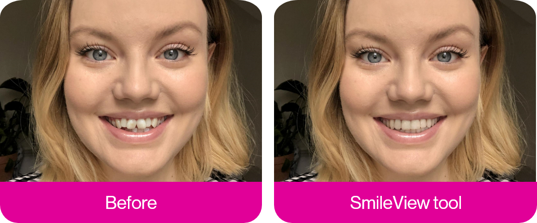 Invisalign before and after smile transformation
